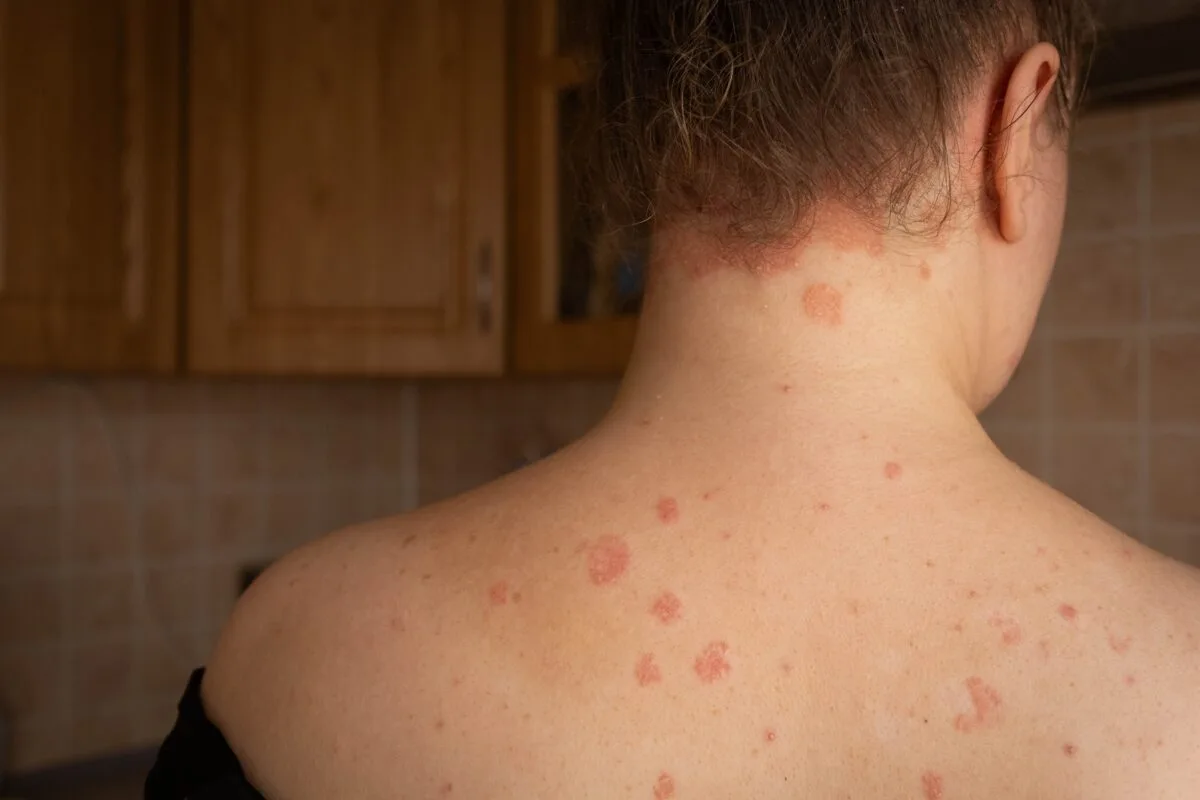 Hoe verzorg ik mijn huid bij psoriasis?